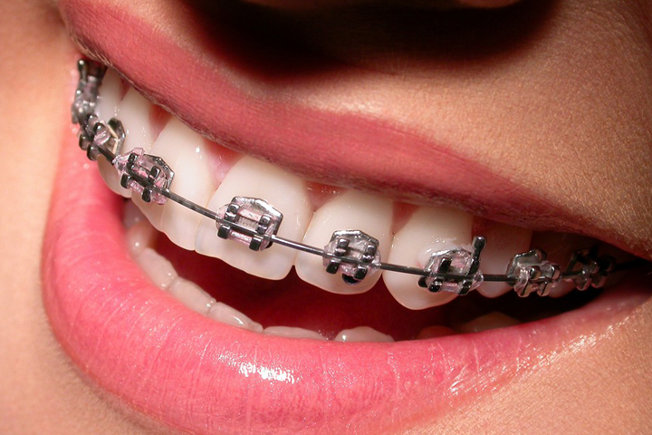 Types of Braces - Orthodontist San Clemente San Juan Capistrano CA